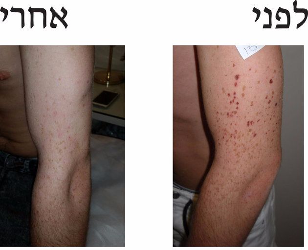 איך תיפרדי מהכתמים תוך חודש ימים